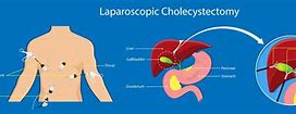 Laparoscopic Cholecystectomy Là Gì