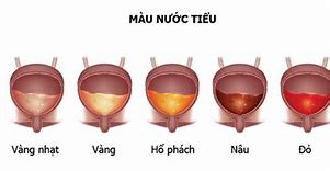 Nước Tiểu Màu Đỏ Là Bệnh Gì